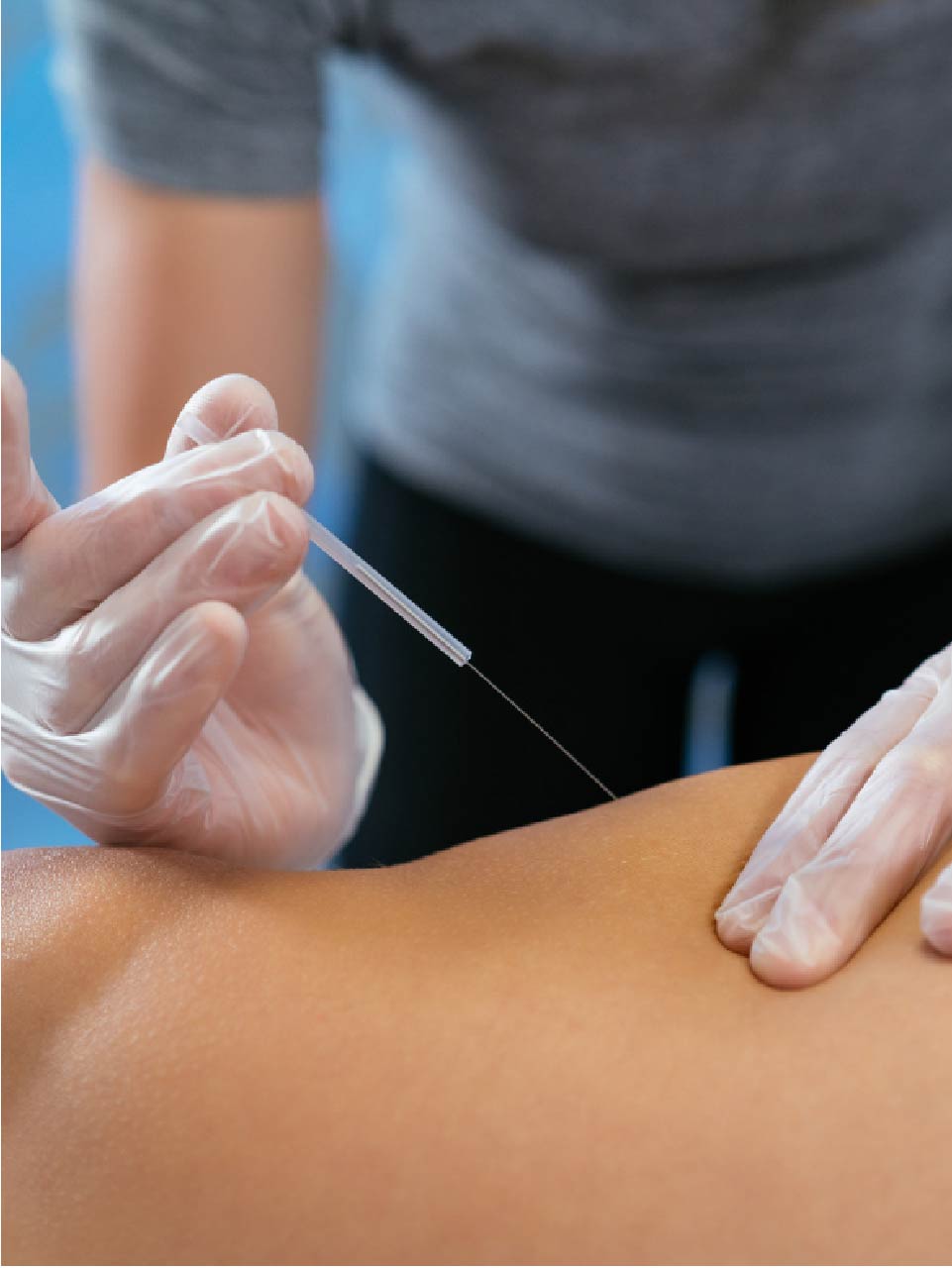 Acupunture