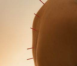 Acupuncture for Summer Stress + Sleep Reset